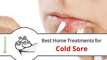Best Home Treatments for Cold Sore