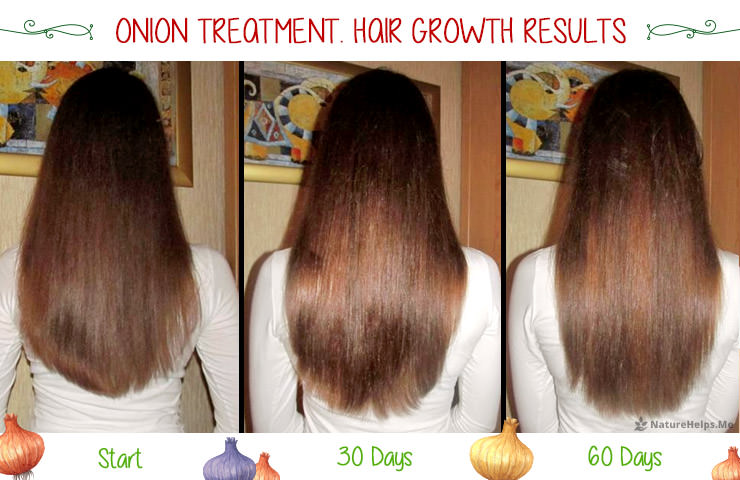 Onion hair mask. Before and After. Growth results