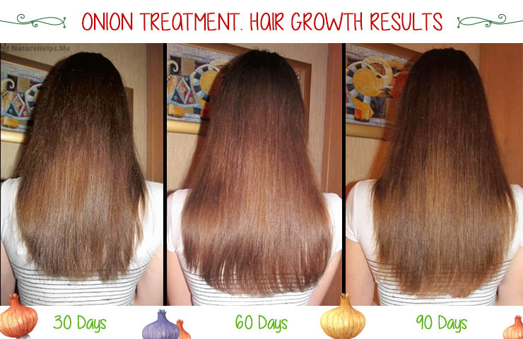 Onion juice hair growth before and after